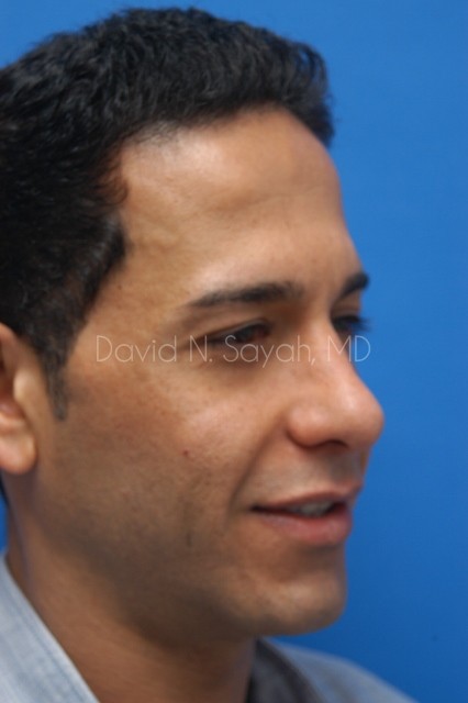 Rhinoplasty Before and After | Sayah Institute