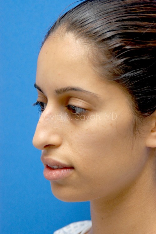 Rhinoplasty Before and After | Sayah Institute
