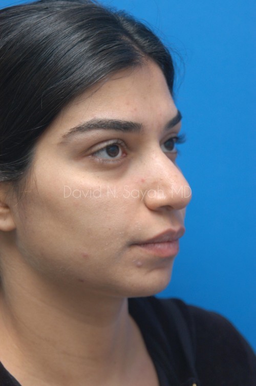 Rhinoplasty Before and After | Sayah Institute