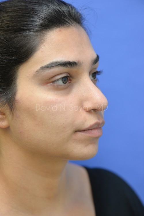 Rhinoplasty Before and After | Sayah Institute