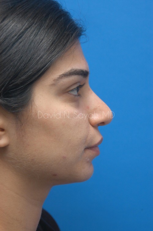 Rhinoplasty Before and After | Sayah Institute