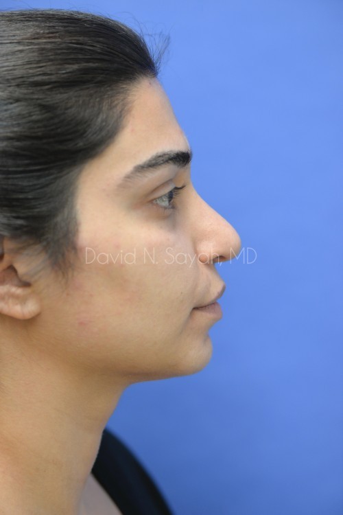 Rhinoplasty Before and After | Sayah Institute