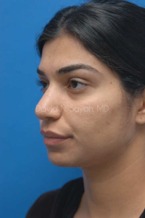 Rhinoplasty Before and After | Sayah Institute