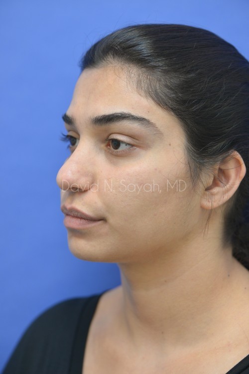 Rhinoplasty Before and After | Sayah Institute