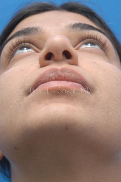 Rhinoplasty Before and After | Sayah Institute