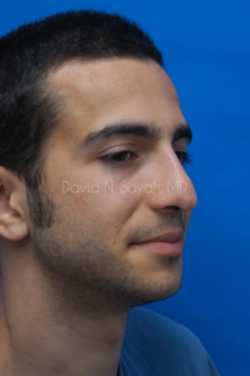 Rhinoplasty Before and After | Sayah Institute