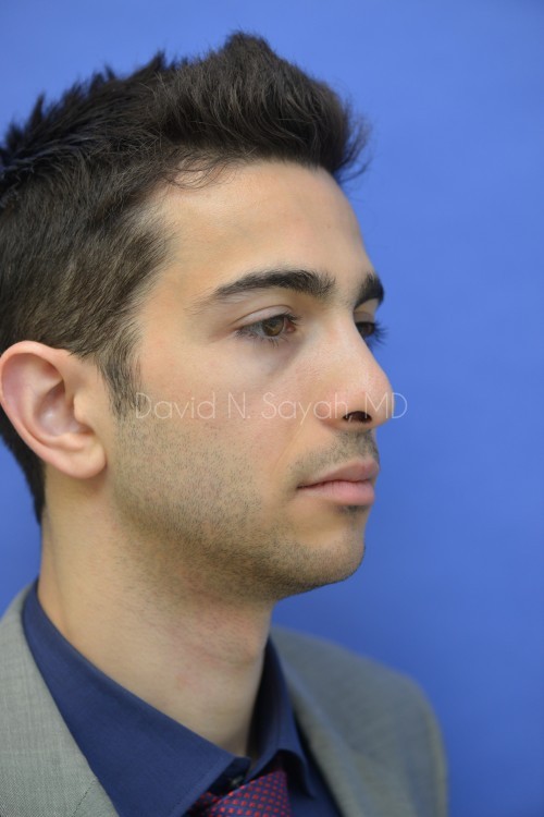 Rhinoplasty Before and After | Sayah Institute