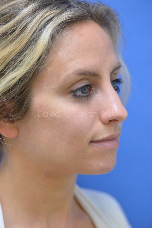 Rhinoplasty Before and After | Sayah Institute
