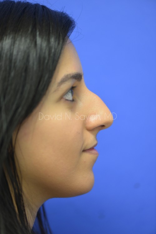 Rhinoplasty Before and After | Sayah Institute