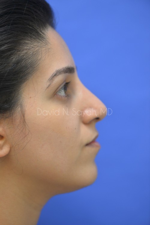 Rhinoplasty Before and After | Sayah Institute