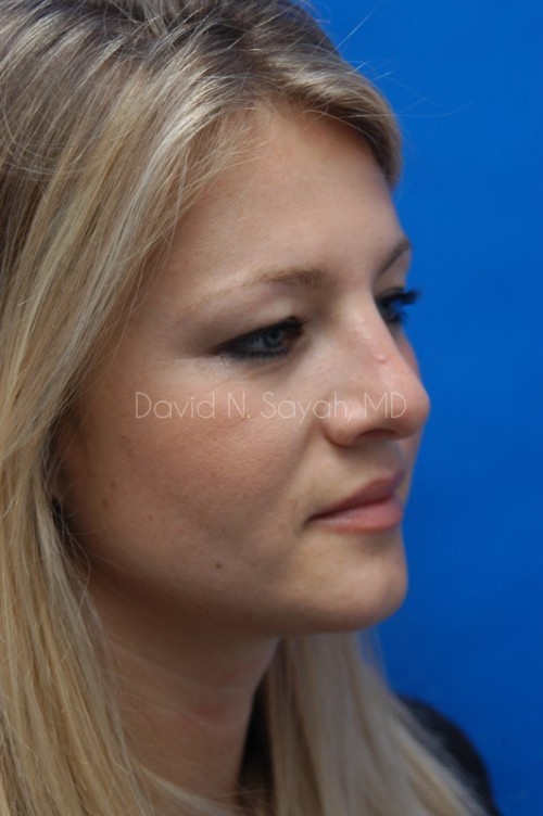 Rhinoplasty Before and After | Sayah Institute
