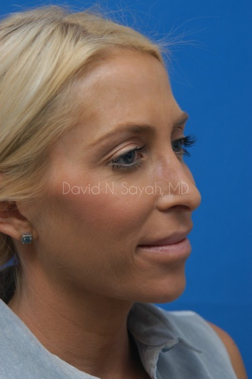 Rhinoplasty Before and After | Sayah Institute
