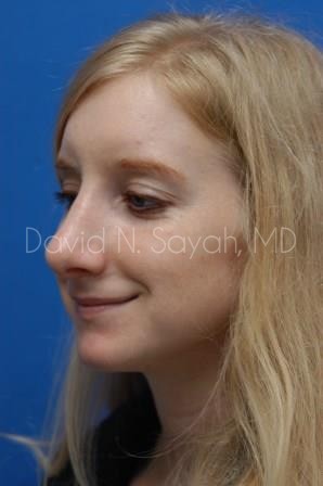 Rhinoplasty Before and After | Sayah Institute