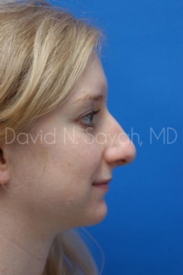 Rhinoplasty Before and After | Sayah Institute