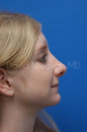 Rhinoplasty Before and After | Sayah Institute