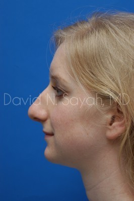 Rhinoplasty Before and After | Sayah Institute