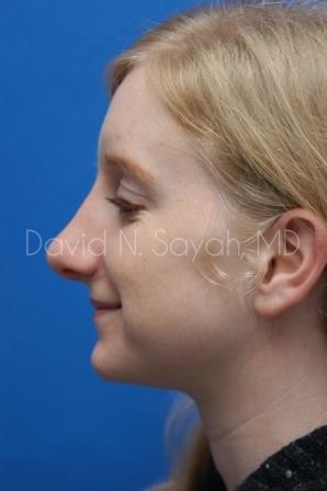 Rhinoplasty Before and After | Sayah Institute