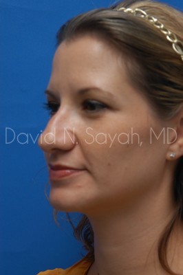 Rhinoplasty Before and After | Sayah Institute