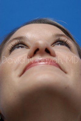 Rhinoplasty Before and After | Sayah Institute