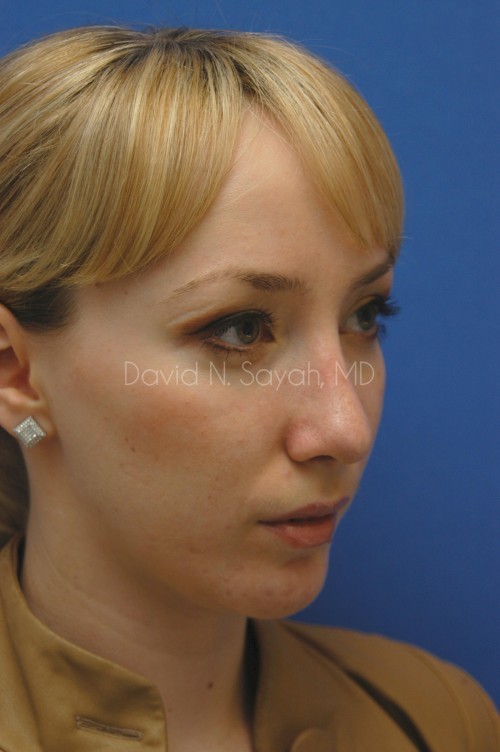 Rhinoplasty Before and After | Sayah Institute