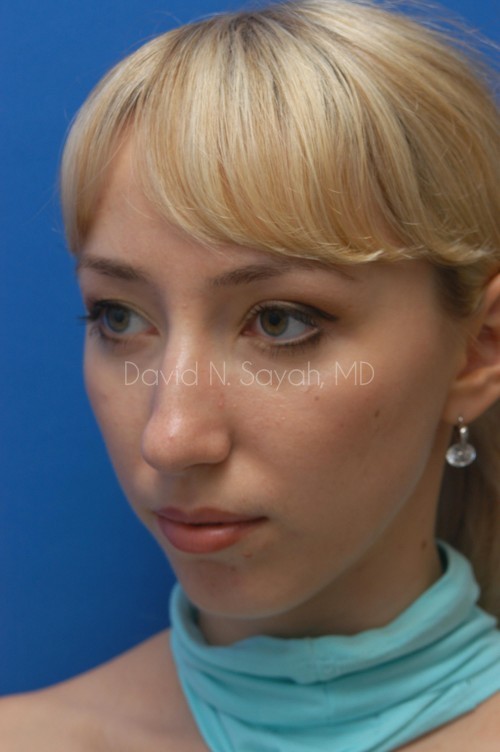 Rhinoplasty Before and After | Sayah Institute