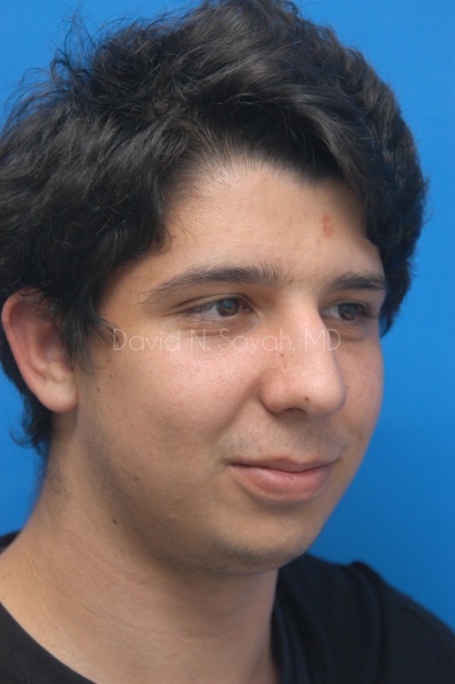 Rhinoplasty Before and After | Sayah Institute