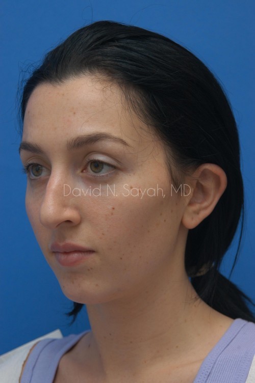 Rhinoplasty Before and After | Sayah Institute
