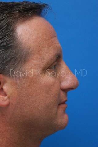 Rhinoplasty Before and After | Sayah Institute