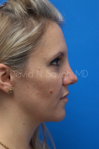 Rhinoplasty Before and After | Sayah Institute