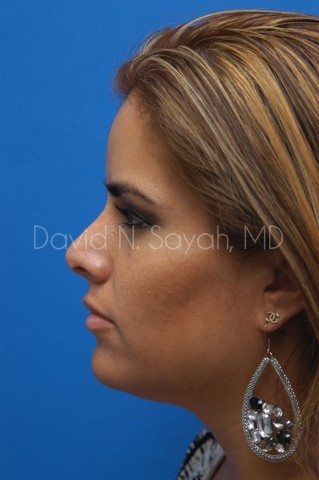 Rhinoplasty Before and After | Sayah Institute