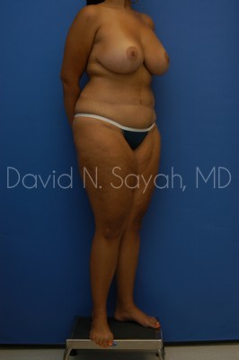 Thigh Lift Before and After | Sayah Institute