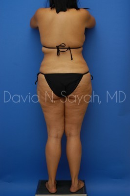 Thigh Lift Before and After | Sayah Institute