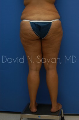 Thigh Lift Before and After | Sayah Institute