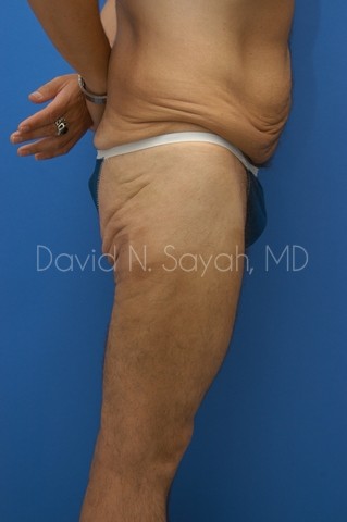 Thigh Lift Before and After | Sayah Institute