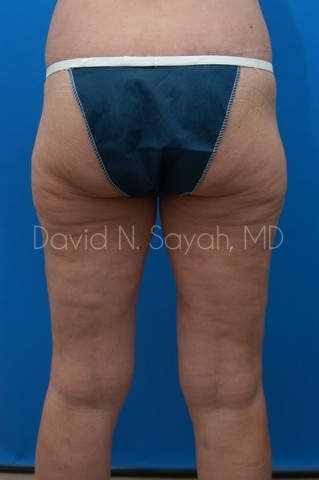 Thigh Lift Before and After | Sayah Institute