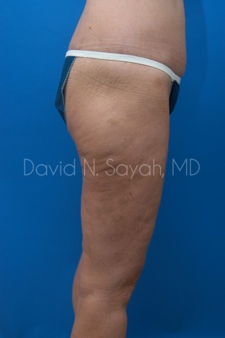 Thigh Lift Before and After | Sayah Institute