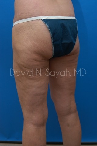 Thigh Lift Before and After | Sayah Institute