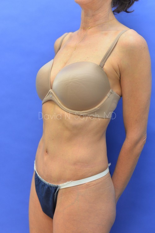 Tummy Tuck Before and After | Sayah Institute