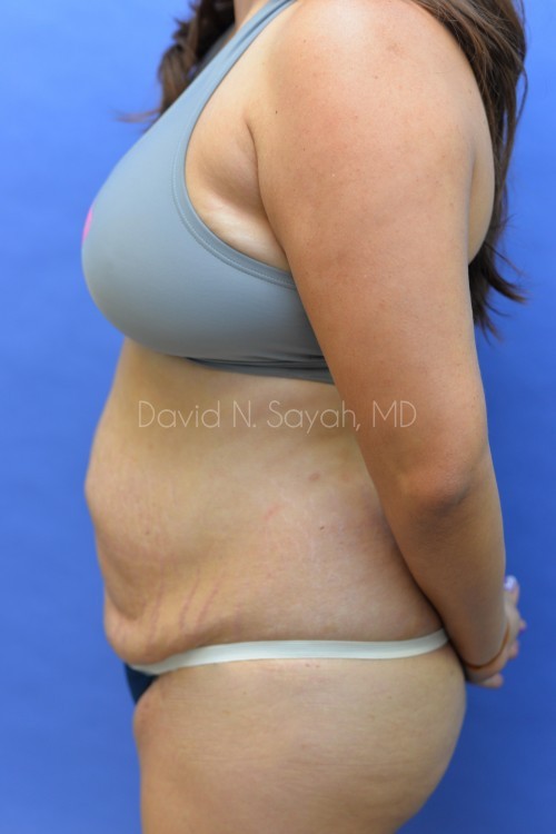 Tummy Tuck Before and After | Sayah Institute