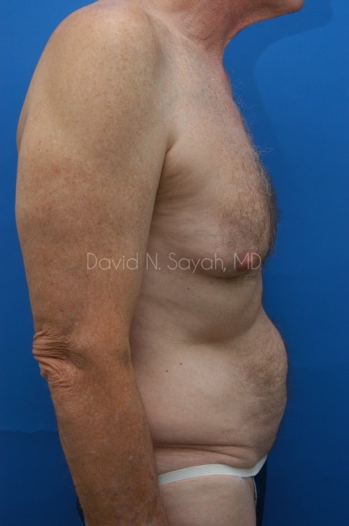 Tummy Tuck Before and After | Sayah Institute