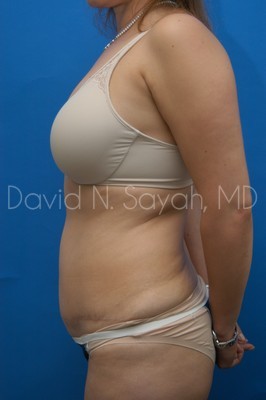 Tummy Tuck Before and After | Sayah Institute
