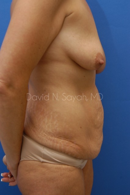 Tummy Tuck Before and After | Sayah Institute