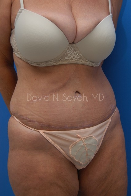 Tummy Tuck Before and After | Sayah Institute