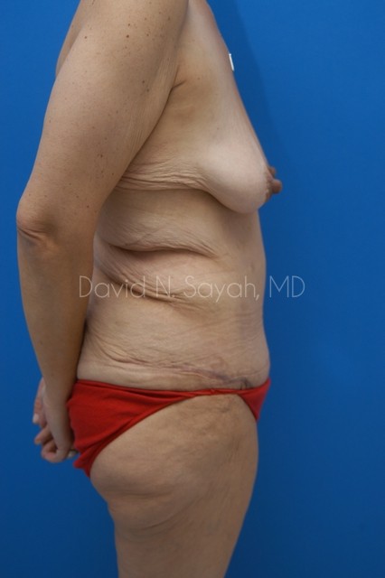 Tummy Tuck Before and After | Sayah Institute