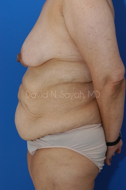 Tummy Tuck Before and After | Sayah Institute