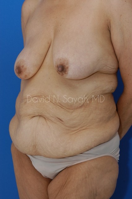 Tummy Tuck Before and After | Sayah Institute
