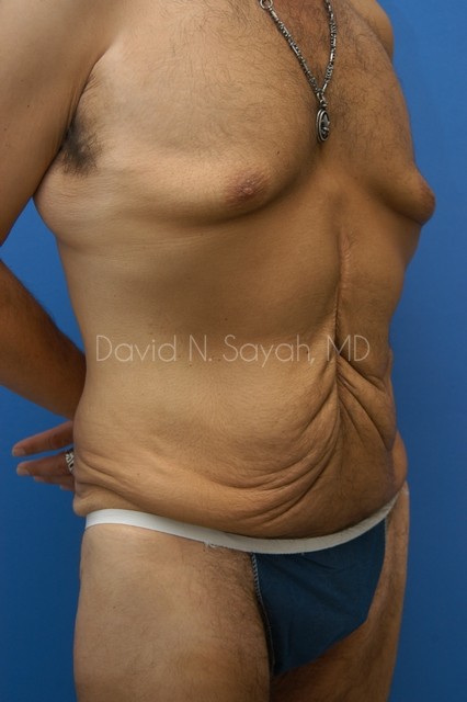 Tummy Tuck Before and After | Sayah Institute