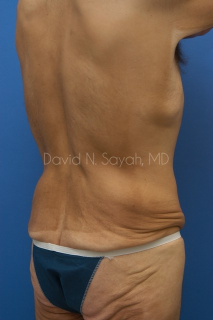 Tummy Tuck Before and After | Sayah Institute