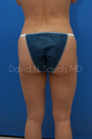 Tummy Tuck Before and After | Sayah Institute