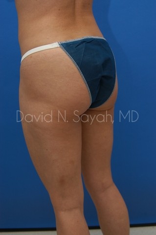 Tummy Tuck Before and After | Sayah Institute